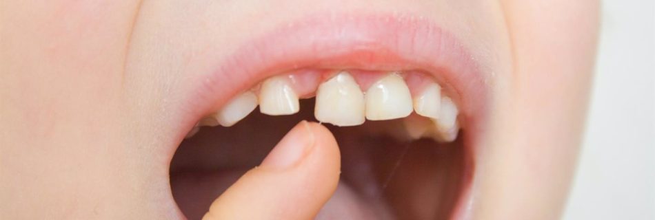 Caries en niños