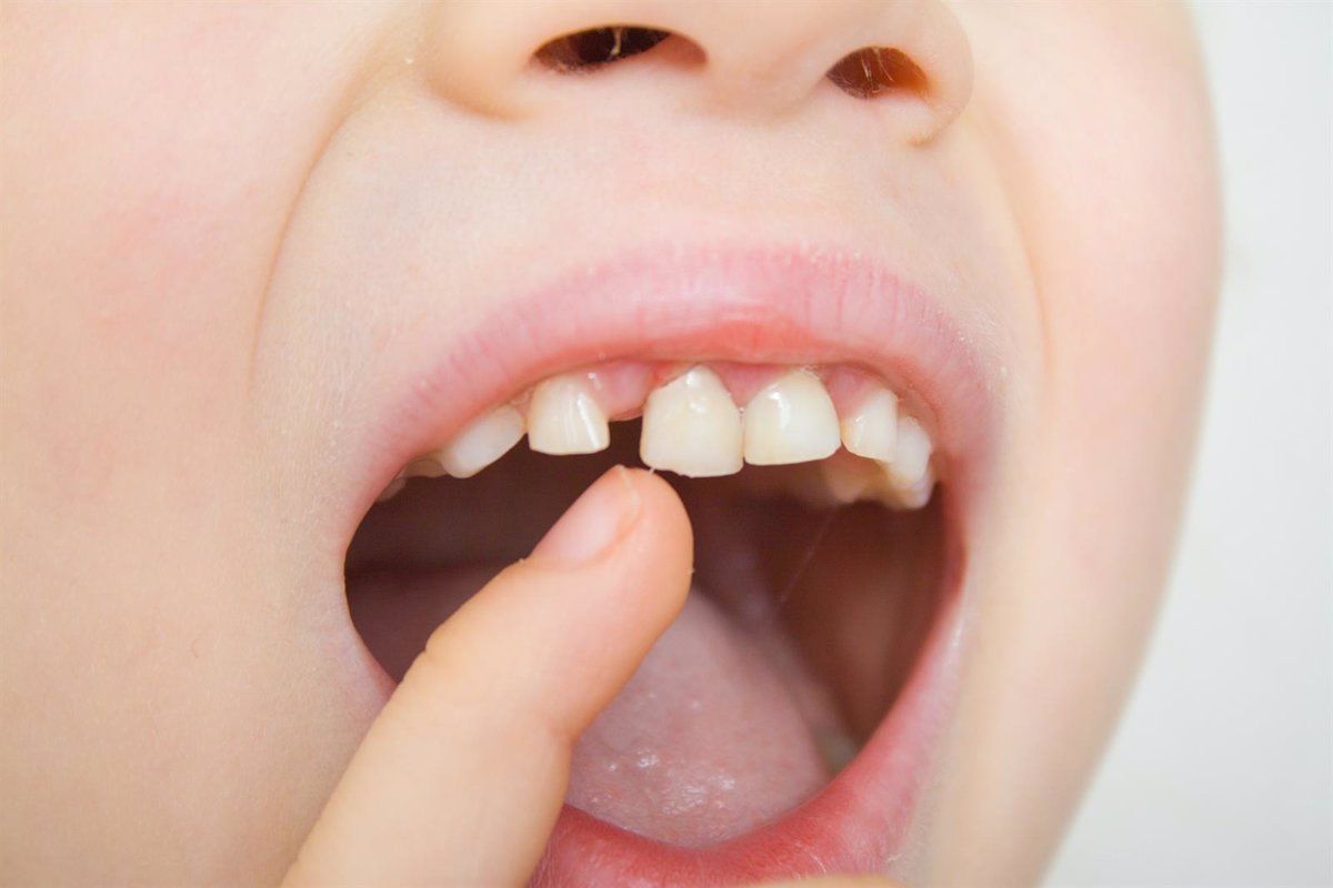 Caries en niños